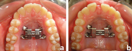 MIARPE - Mini Implant Assisted Rapid Palatal Expansion (Tam Set)