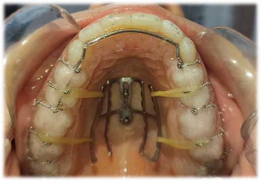 Palatal Power Arm ve Palatal Connector Seti