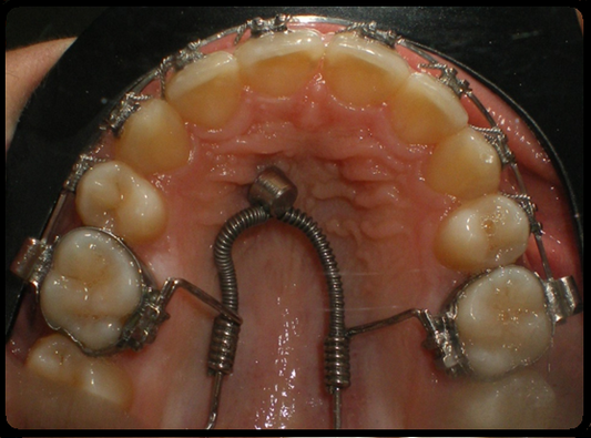 Palatal Sliding Distalizer / Mesializer (Tam set)