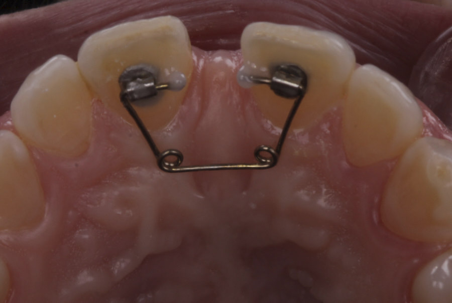 Leone Medıan Diastema Closing Kit